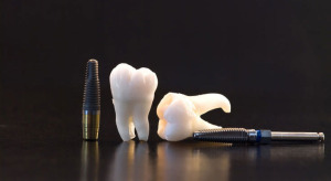 implants dentaires dents